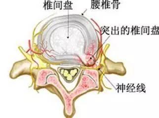 腰突压迫神经腿疼.jpg 腰突压迫神经腿疼.jpg