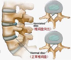 腰椎间盘突出.jpg 腰椎间盘突出.jpg