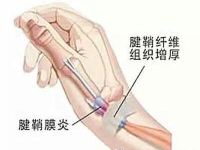 腱鞘炎.jpg 腱鞘炎.jpg