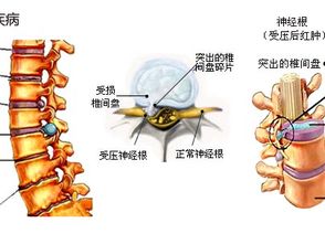 腰椎间盘突出体征 腰椎间盘突出体征