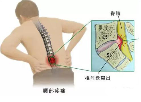 腰椎间盘突出腰痛原因 腰椎间盘突出腰痛原因