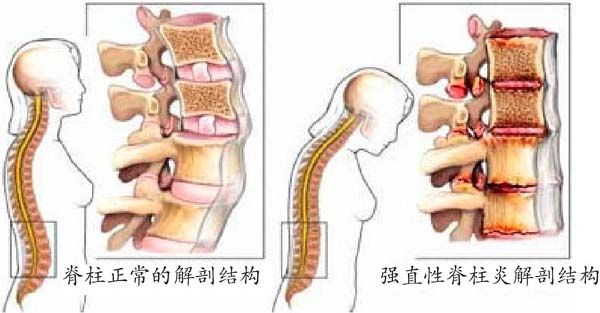 强直性脊柱炎症状1 强直性脊柱炎症状1