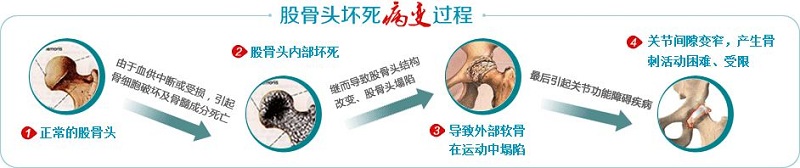 股骨头坏死病变过程 股骨头坏死病变过程