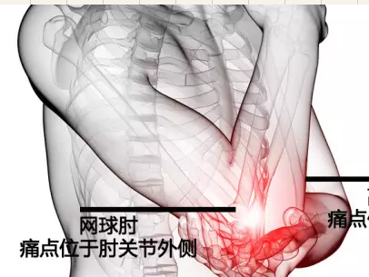 网球肘.jpg 网球肘.jpg