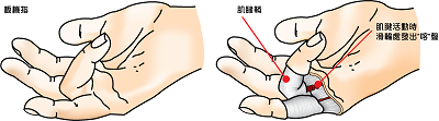 腱鞘炎54.png 腱鞘炎54.png