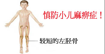 小儿麻痹