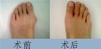 拇外翻术前术后.jpg 拇外翻术前术后.jpg