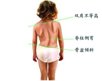 脊柱侧凸的治疗.jpg 脊柱侧凸的治疗.jpg
