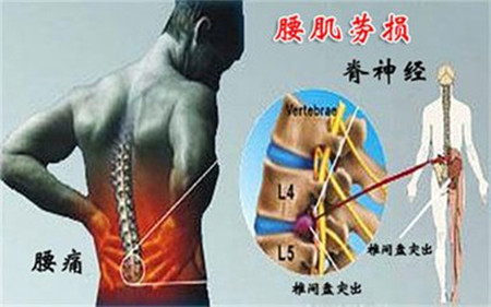 腰肌劳损 fongtu.jpg 腰肌劳损 fongtu.jpg