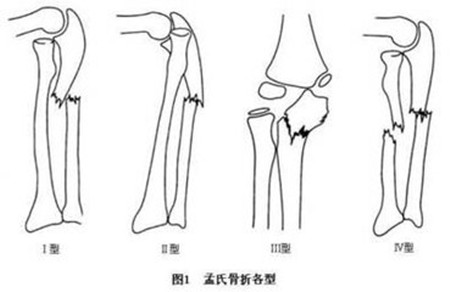 孟氏骨折_副本.jpg 孟氏骨折_副本.jpg